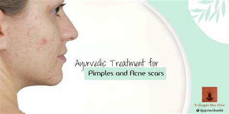 Ayurveda For Pimples Acne Scars Blog By Ayurvedic Dermatologist