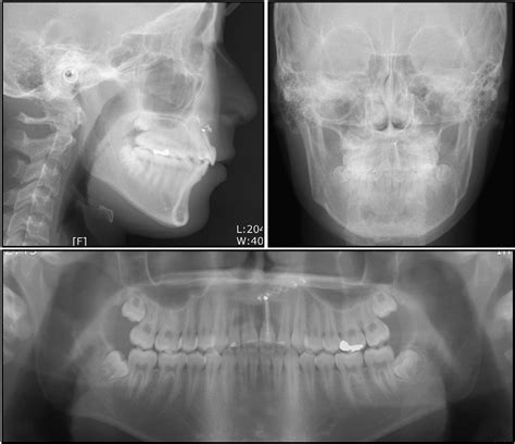 Figure 14 From Orthodontic Treatment Of An Ankylosed Maxillary Central Incisor Through Single