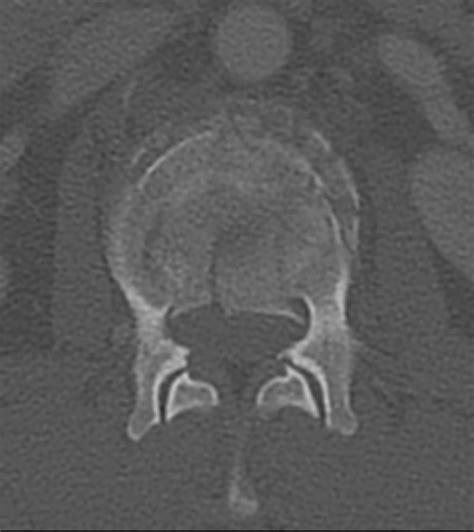 Figure 2 From Review Of The Imaging Features Of Benign Osteoporotic And Malignant Vertebral