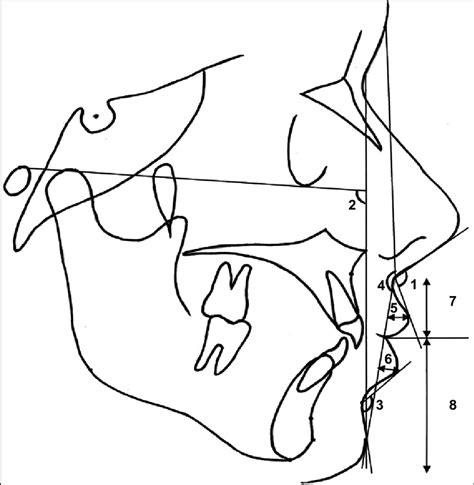 Soft And Hard Tissue Measurement 1 Nasolabial Angle 2 Facial Download Scientific Diagram