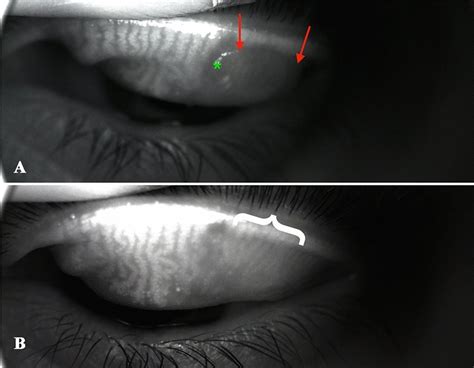 Meibomian Gland Morphology For Upper Lid With Chalazion Asterisk A