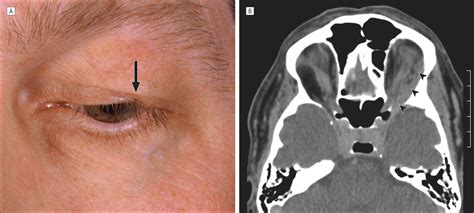 Delayed Diagnosis Of Microcystic Adnexal Carcinoma In Progressive Eyelid Distortion