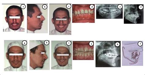 Correction Of Vertical Maxillary Excess By Superior Repositioning Of