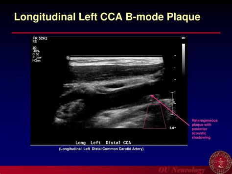 Ppt Introduction To Carotid Ultrasound And Transcranial Doppler