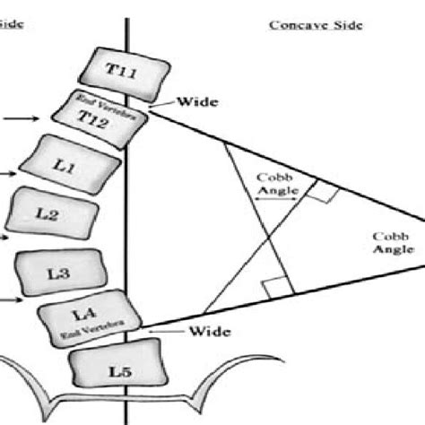 Sagittal View Of Scoliosis Affected Spinal Canal Registration And Atlas