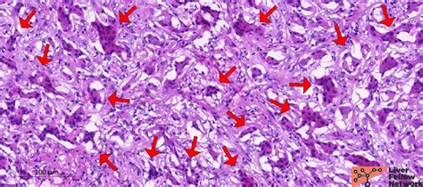 Bile Duct Neoplasms Focus On Bile Duct Adenoma And Its Evaluation In