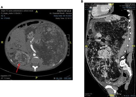 Frontiers Case Report A Hybrid Technique For A Safe Nephrectomy In A