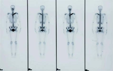 99m Tc Mdp Bone Scintigraphy Showed An Abnormal Nuclide Concentration