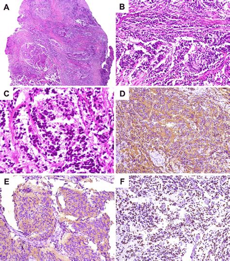 Microscopic Features Of Metastatic Neuroblastoma Case A Lobular