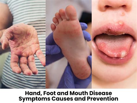 Hand Foot And Mouth Disease Symptoms Causes And Prevention Sprint