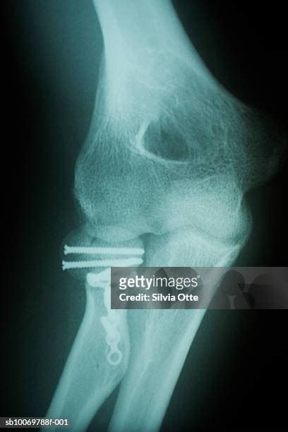 103 Broken Elbow X Ray Stock Photos, High-Res Pictures, and Images ...