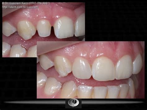 Fechamento De Diastema E Faceta Direta Em Dente Conóide Artigo Ident