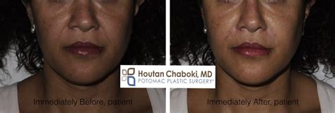 Belotero®, a facial filler for nonsurgical rejuvenation