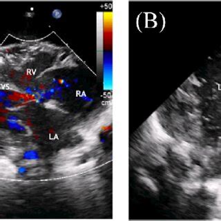 ECHO. (A) Subcostal view. The right and left atrium are normal. The ...