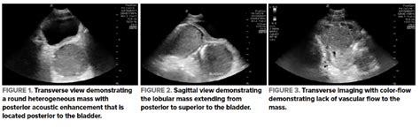 Abdominal Abscess Drainage