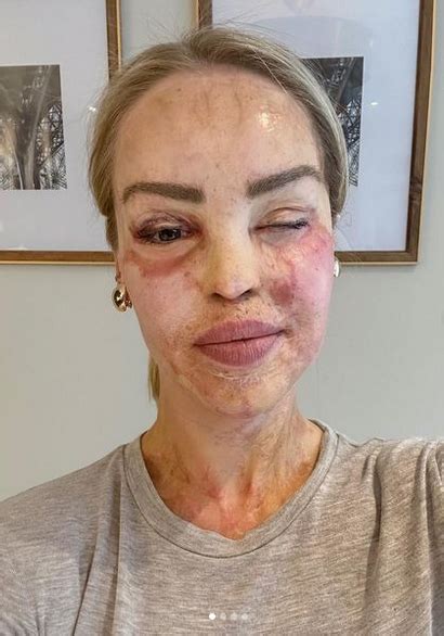 Katie Piper Eye Surgery What Happened To Katie Piper Newsfinale