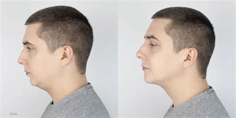 Your Top Chin Augmentation Options | Dr. Weinfeld