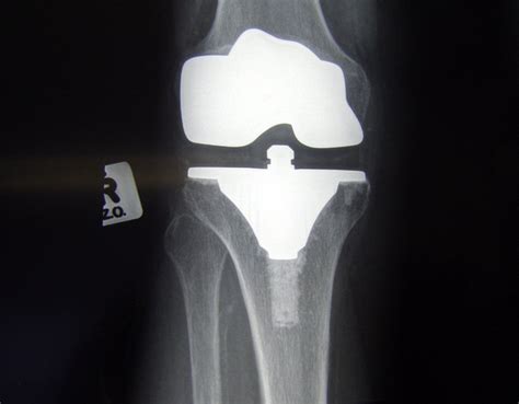 Knee replacement - front view Free Photo Download | FreeImages