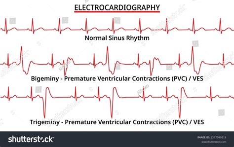 Trigeminy Images Stock Photos Vectors Shutterstock