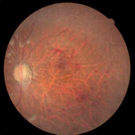 Fluorescein Angiography Of The Left Eye 3 Months After Vitrectomy Download Scientific Diagram