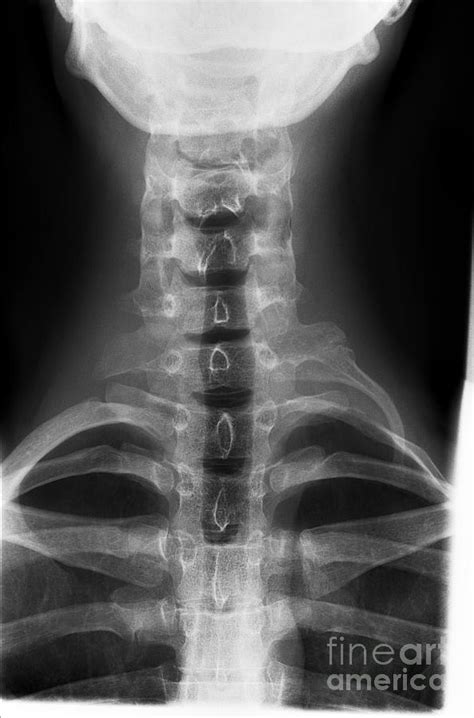 Cervical Rib, X-ray Photograph by Science Photo Library