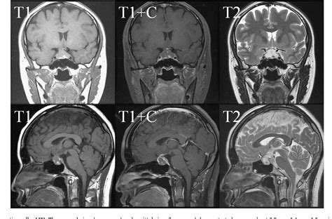 Figure From Pituitary Spindle Cell Oncocytoma Presented As Pituitary