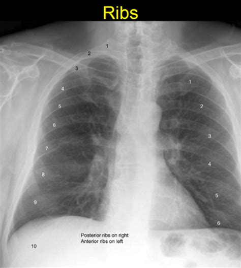 Right Atrium Chest X Ray