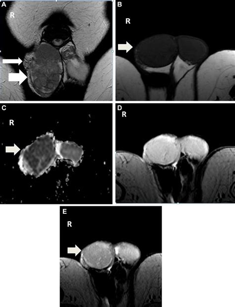 Right Testicular Seminoma In A 42 Year Old Man Invading The Testicular