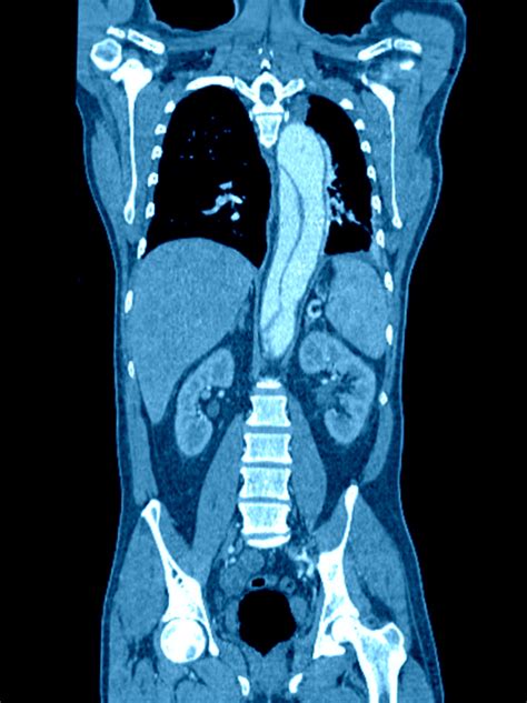 IV contrast for CT is not associated with increased risk of acute ...