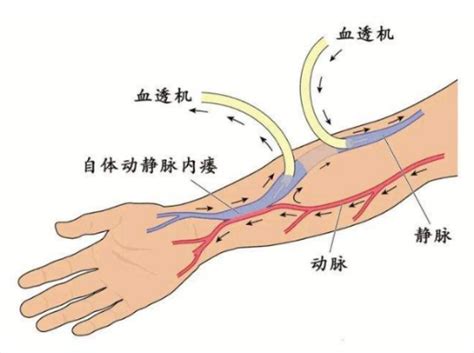 【新技术】守护透析患者生命线，我院顺利开展动静脉内瘘球囊扩张术（pta） 惠东县人民医院