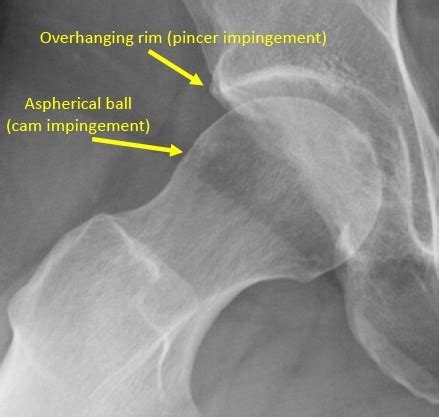 Case Study: Arthroscopic Hip Surgery for Femoroacetabular Impingement ...