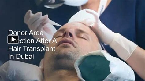 Ppt Donor Area Infection After A Hair Transplant In Dubai Powerpoint