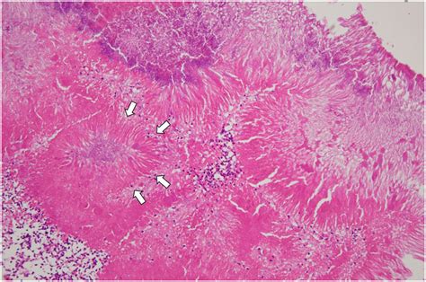 Paranasal Sinus Actinomycosis Treated With A Combination Of Surgery And Long Term Low Dose