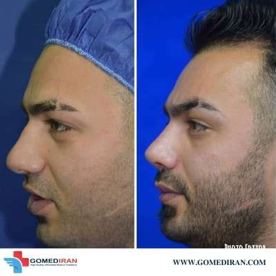 Rhinoplasty In Iran Nose Job In Iran Nose Job Cost Gomed