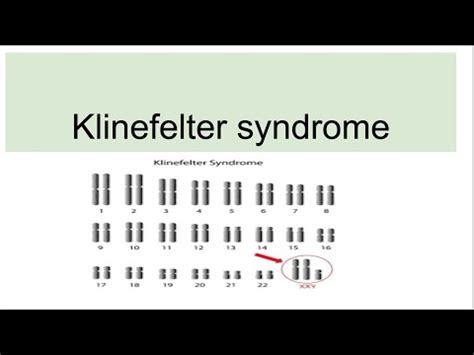 Klinefelter syndrome---Genetics, Characteristics, Diagnosis : genetics