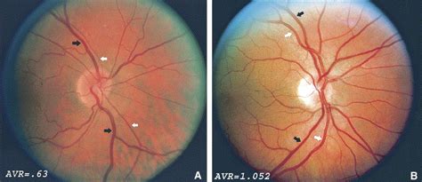 Computer Assisted Measurement Of Retinal Vessel Diameters In The Beaver