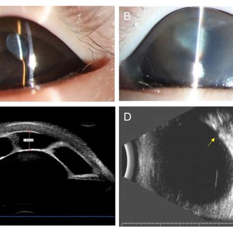 Anterior Segment Photography Corresponding Ultrasound Biomicroscopy Download Scientific