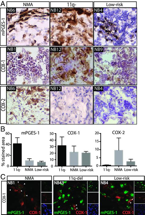 Cox Mpges 1 Expression In Human Neuroblastoma Tumors A Ihc Analysis