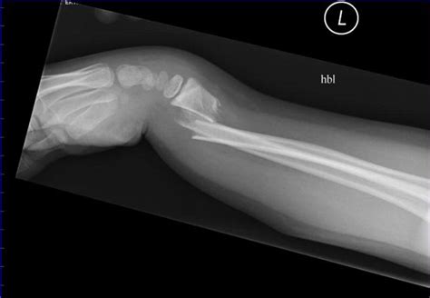 Colles Fracture The Colles Fracture Is The Most Common Pathology