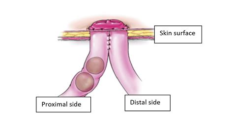 What Is A Stoma Enterostomy