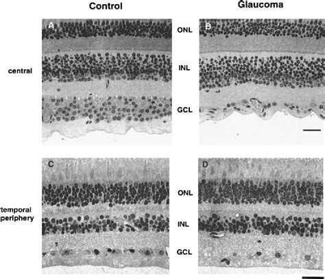 Figure 2 From Ganglion Cell Losses Underlying Visual Field Defects From