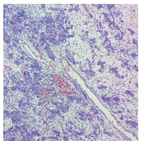 These Are Two Figures Of Malignant Sex Cord Tumor Consistent With Download Scientific Diagram