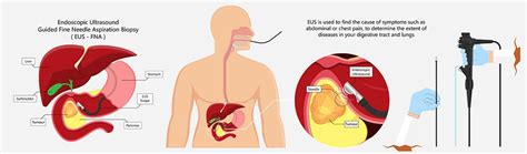 Endoscopic Ultrasound Eus Singapore Endoscopy Procedure