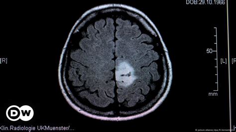 Brain Tumors In Children — When All That Matters Is Now Science In