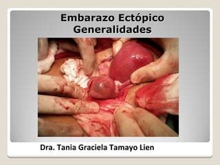 Embarazo Ectopico Generalidades Pdf