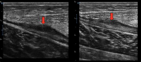 Soft Tissue Healing Great Northern Physiotherapy