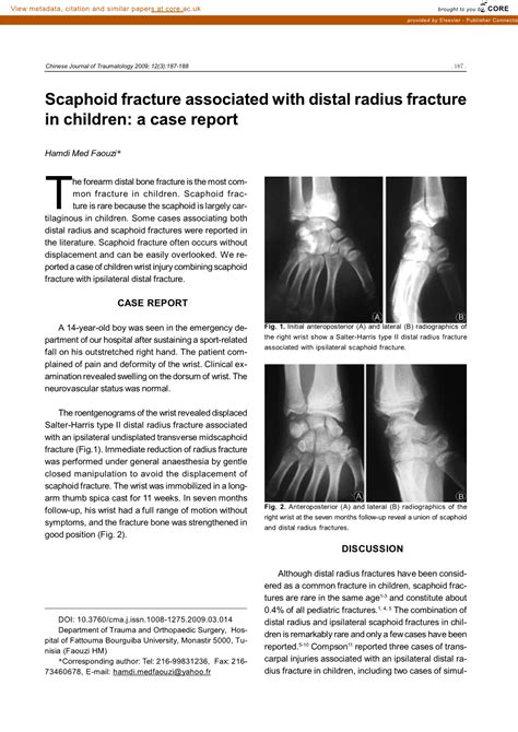 Scaphoid Fracture Associated with Distal Radius Fracture in Children: a ...