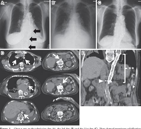 Figure 1 From Axillofemoral Bypass Markedly Improved Acute Decompensated Heart Failure And