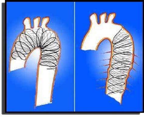 Prophylactic or very early strengthening of Aortic Arch and Descending... | Download Scientific ...