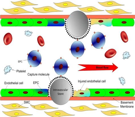 Illustration Of Intravascular Stent Implantation Causing Endothelial